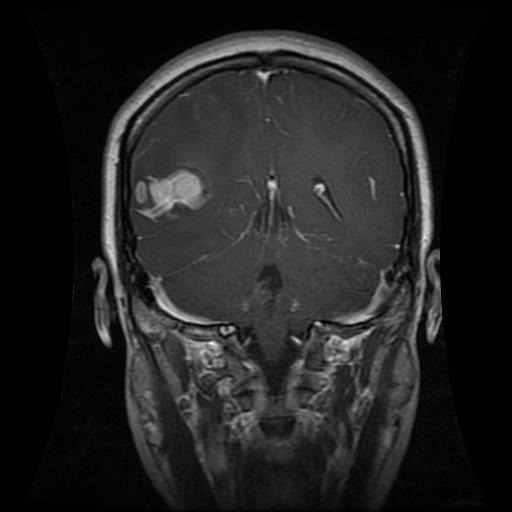 Glioma sample