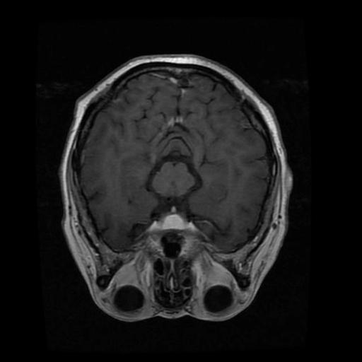 Meningioma sample