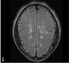 No Tumor sample