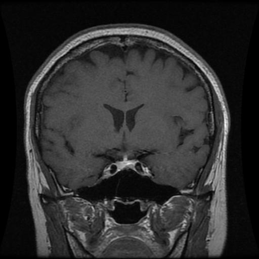 Pituitary sample